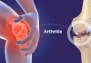 Natural Supplements for Arthritis