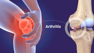 Natural Supplements for Arthritis